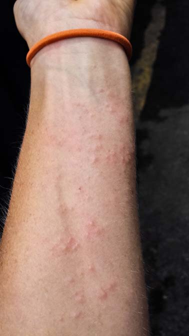 skin rash on forearm #10